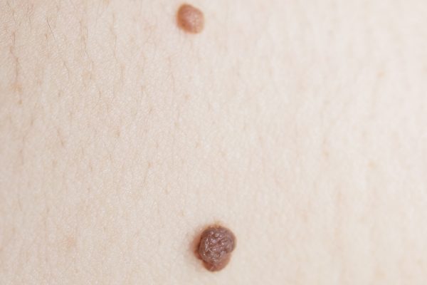 How Do You Get Rid of Skin Lesions? featured image
