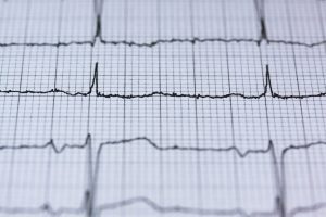 What Does an EKG Test For? featured image