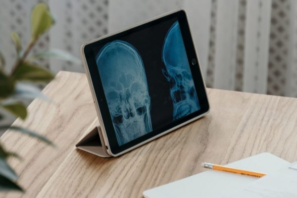 What is the Difference Between a Normal X-ray and a Digital X-Ray? featured image