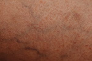 How do I Prepare for a Vascular Test? featured image
