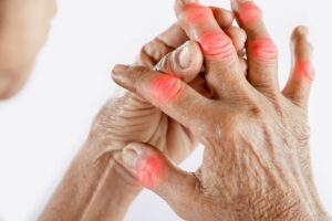 Arthritis in Summer: Causes, Triggers & Management featured image